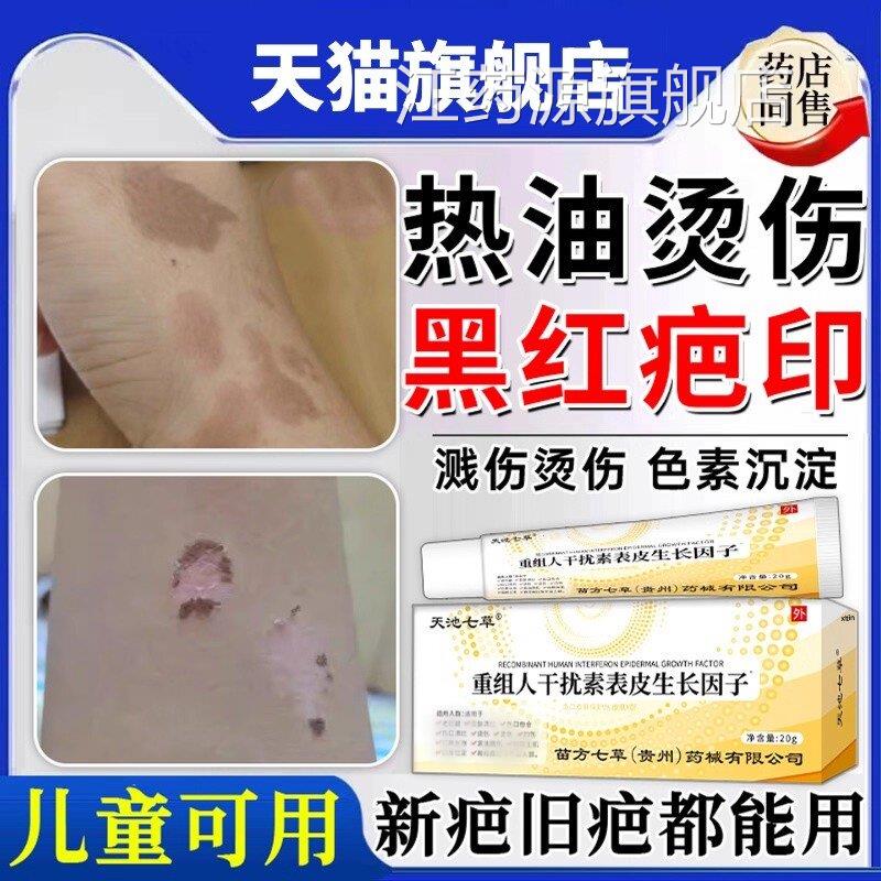 热油油去烫伤烧伤去疤膏疤痕修复除疤膏儿童祛红印黑印色素沉淀20
