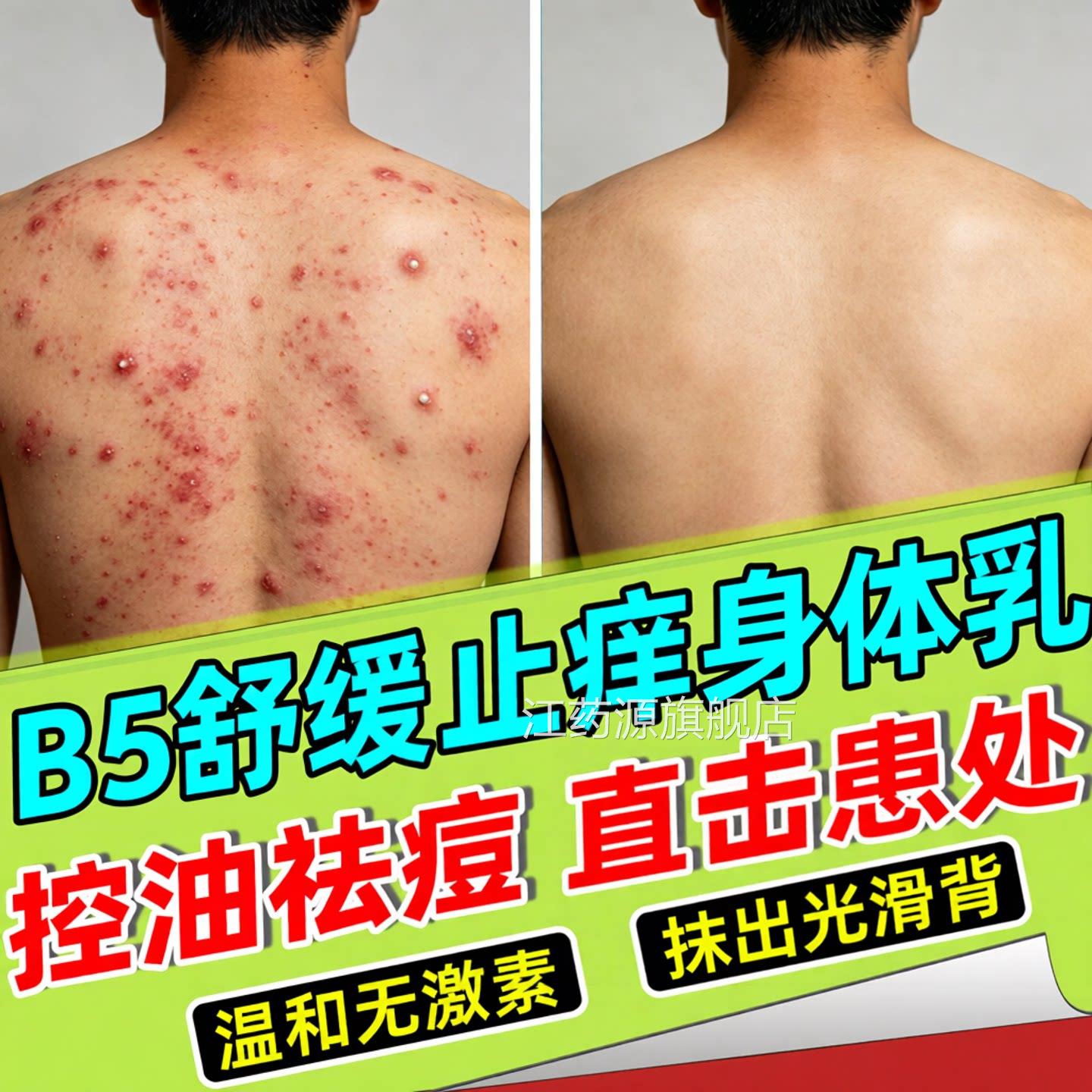 祛马拉色菌前胸后背部痘过氧化苯甲酰粉末黑印身体乳涂抹身体乳膏