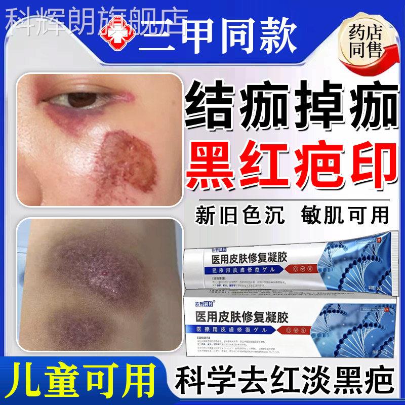 掉童痂后去红印修复退红淡印面部黑印儿摔伤擦伤点痣后祛疤膏液TK