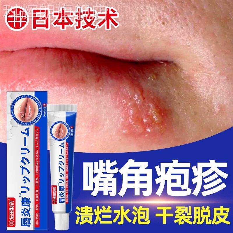 唇炎唇膏嘴唇干 干裂脱皮去死皮滋润唇膜口角炎修唇炎专用唇护膏