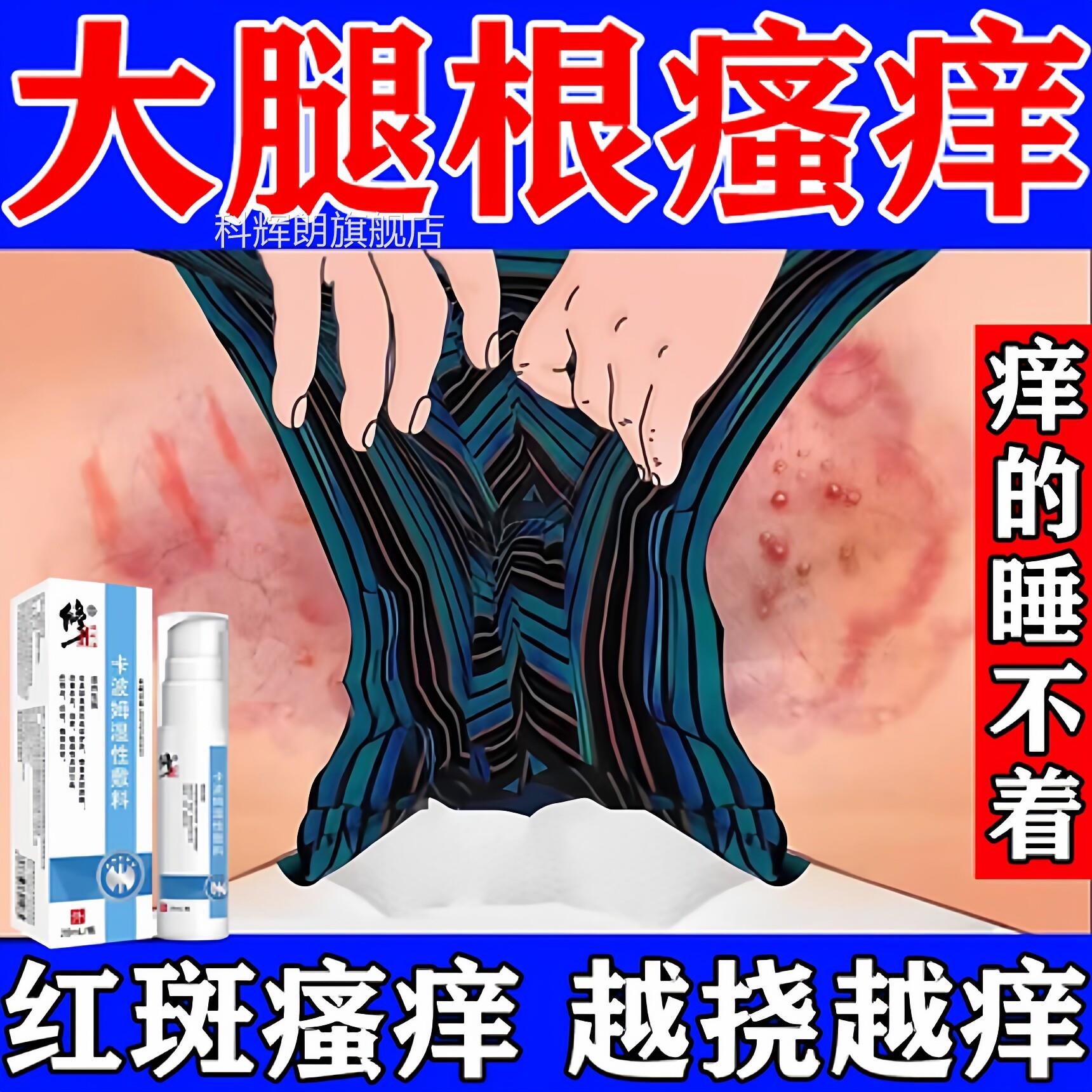 烧档药大腿内侧防摩擦胖人夏天走路男女根部潮湿出汗红肿磨破膏痛