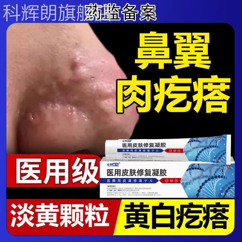 面部鼻子鼻颗翼上肉疙瘩皮脂腺增生异位症鼻赘小粒丘疹去除药膏TK