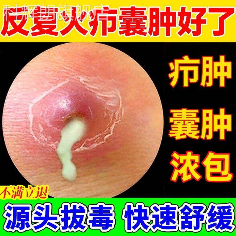 断痒拔毒膏皮脂腺囊火疖子膏药去除粉瘤囊肿脓贴长肿痘坐疮神正品