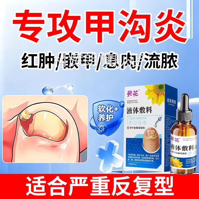 甲沟炎息肉去除软化剂药疗嵌甲肿治防止指甲往肉里长消红膏矫正器