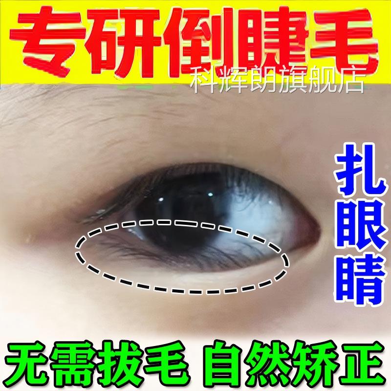 倒睫毛矫正贴成人婴儿睫毛倒长眼睑下垂拉眼皮儿童提专用神器正品