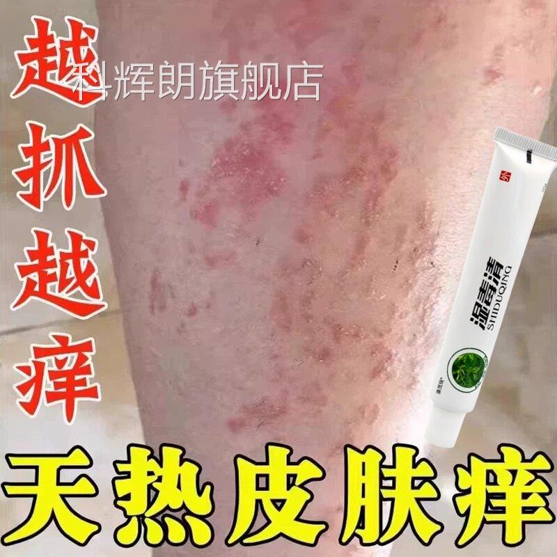 夏天小腿痒瘩湿成人止痒膏出汗身上痒天热皮肤痒热疙红疹热毒科辉