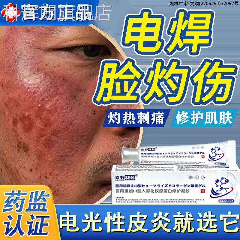 电焊烤脸复脸部灼伤发修红干燥脱皮专用电弧烧伤药房同款烫伤膏BD