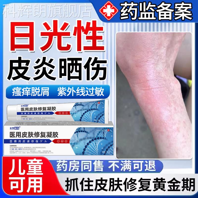 日光性皮炎紫外线过敏发痒太阳晒伤皮肤修复霜专用瘙药房同款膏Y7