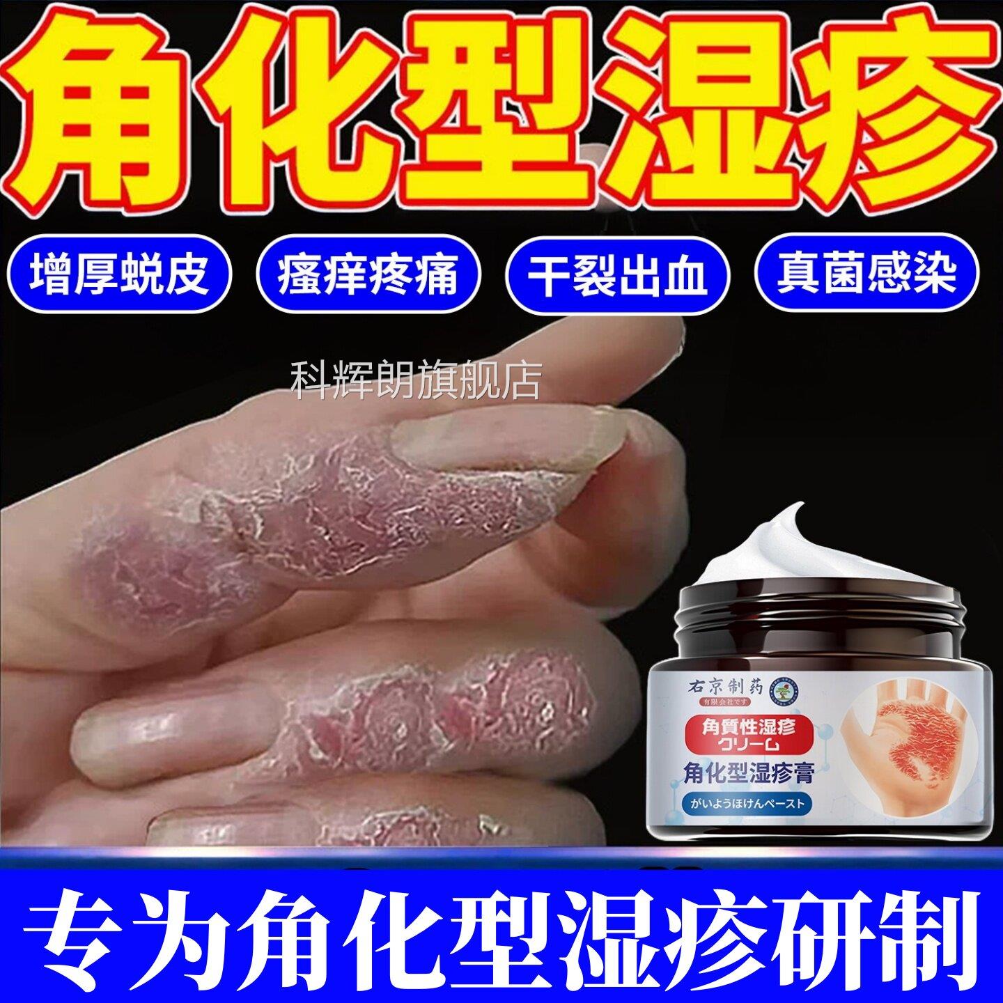 角化型湿疹手部皮干真裂菌感脱染止专用痒手足癣去手脚止根部痒膏