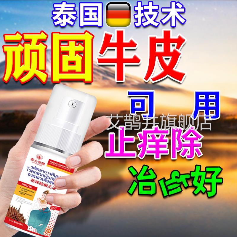 进口牛皮银屑病用膏药正品杀菌止皮效痒肤体股瘙特痒根去喷剂艾鹊