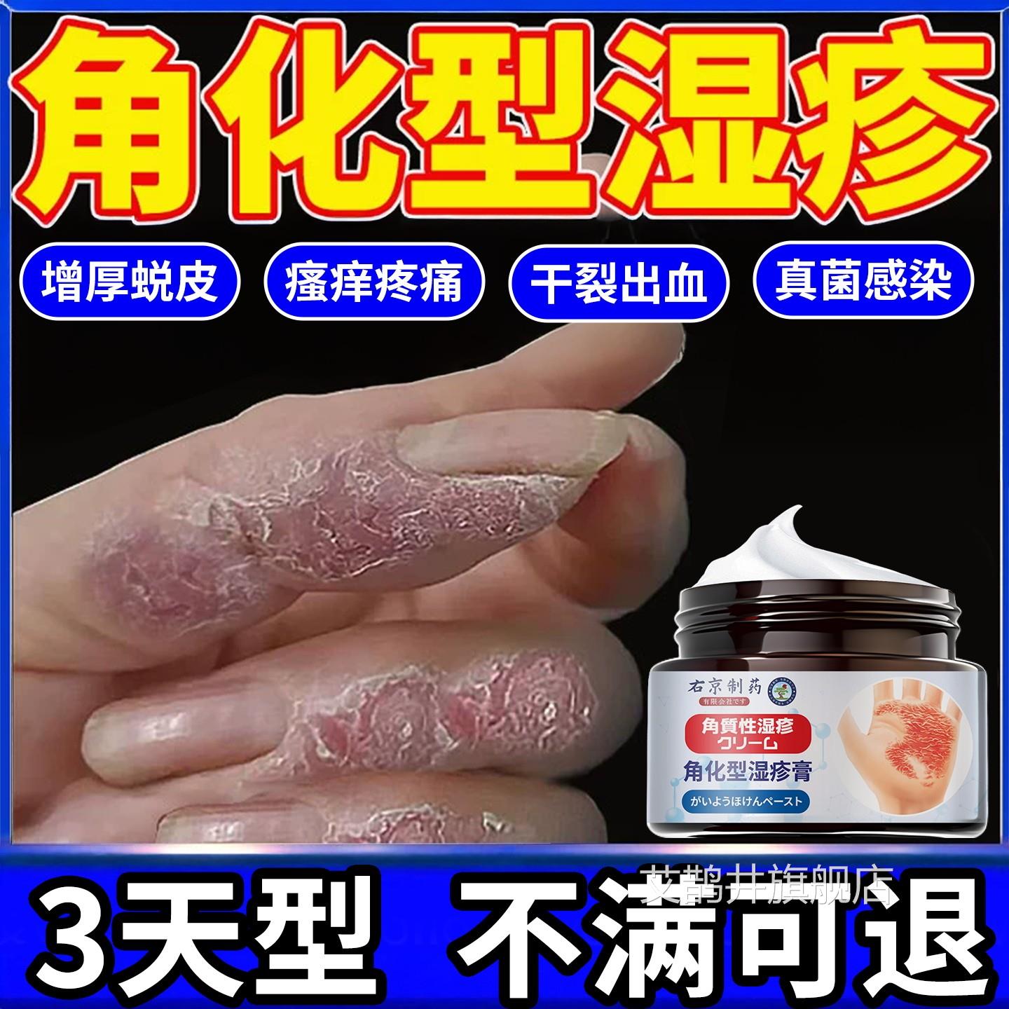 角化型湿疹手部脱皮干裂真菌感染止止痒专用手足癣去手脚根部痒膏