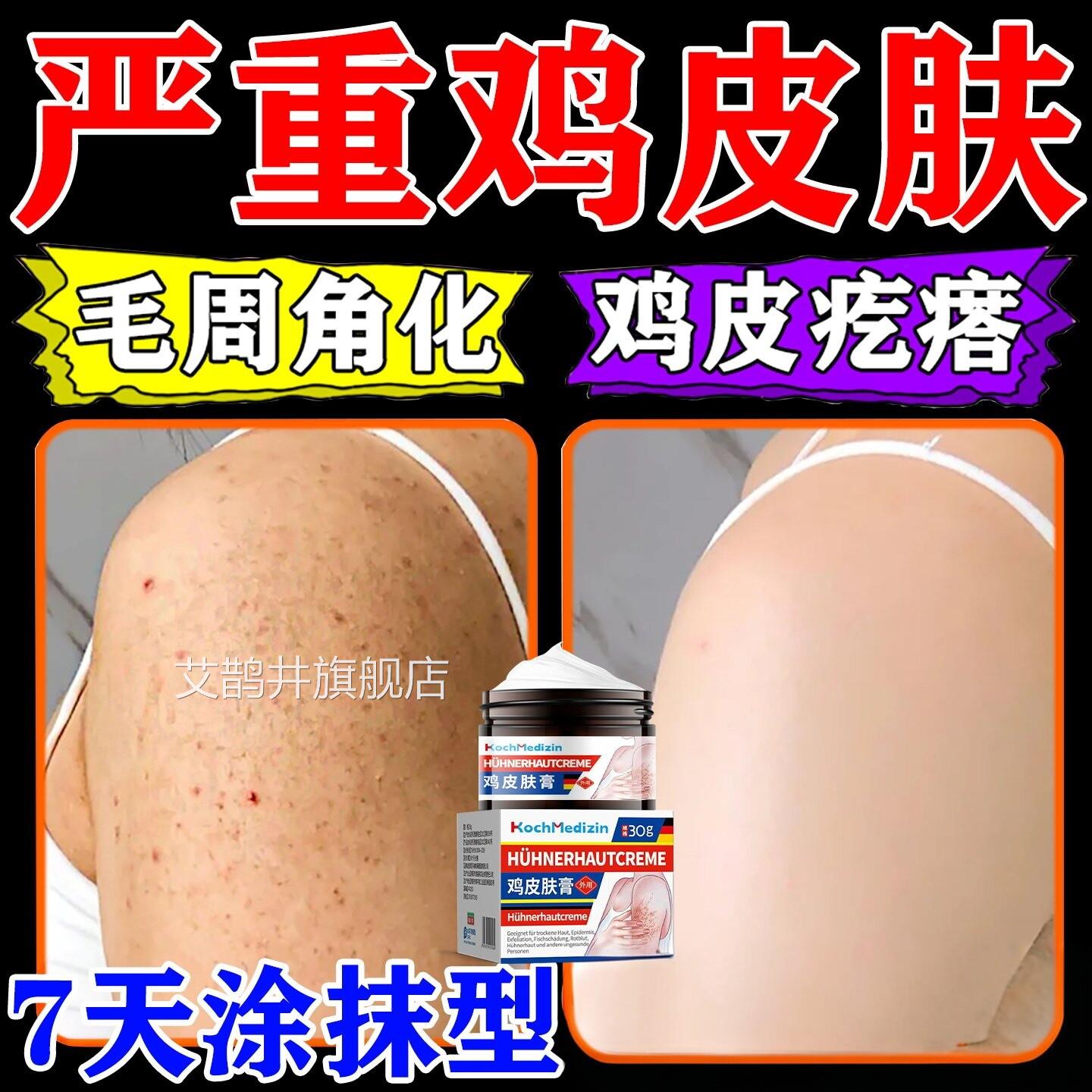 鸡皮肤瘩毛囊角化症专除神器全身疙手臂鸡皮大腿部毛囊炎痘痘艾鹊