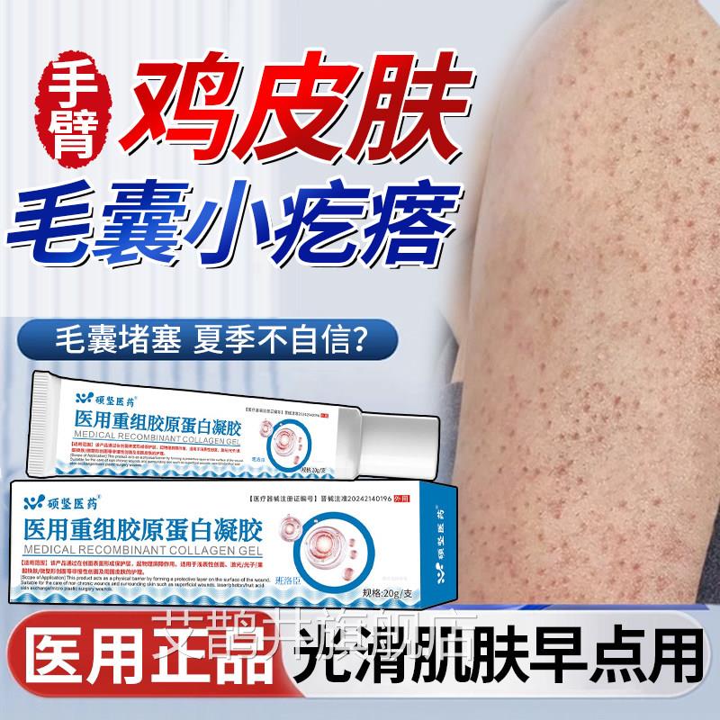 鸡皮肤疙囊瘩毛角化症儿童手臂毛囊炎专用膏周胳膊上长疙瘩去除u9