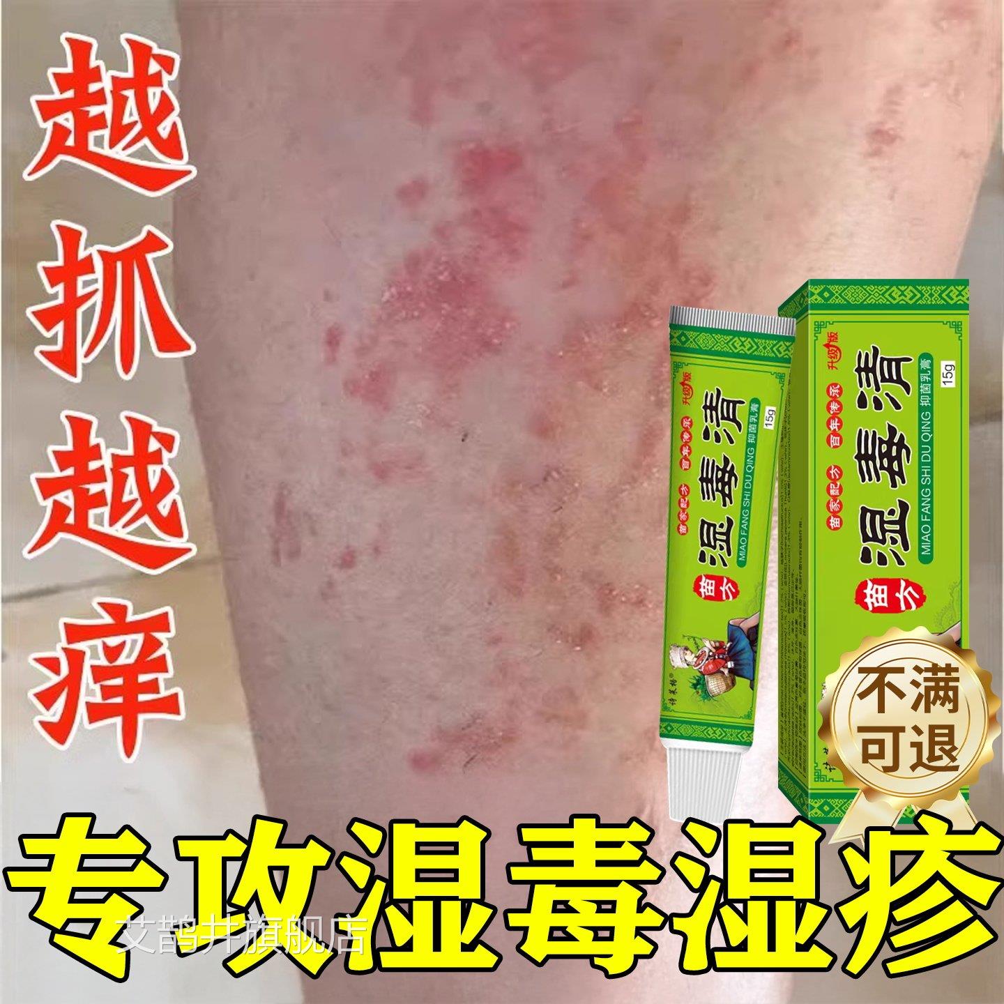 湿毒清软膏湿祛根痒湿痒热止皮肤皮炎瘙痒水泡治除湿专用膏艾鹊井