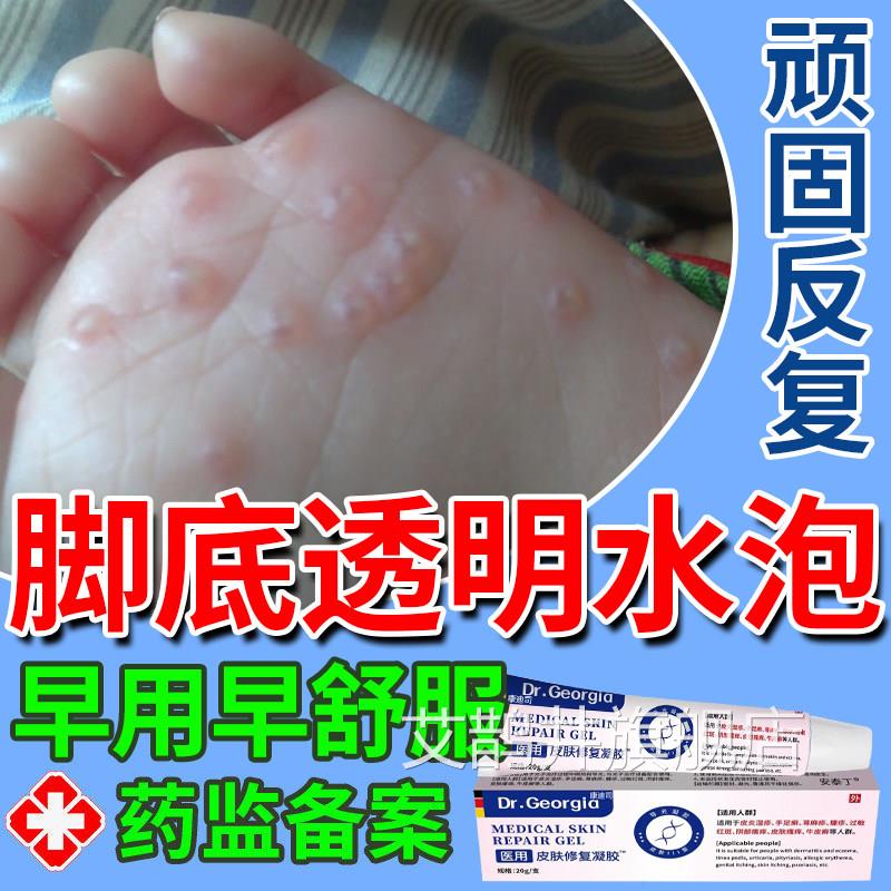 脚上底汗疱疹去脚底起小水泡又痒又脱皮瘙痒根止痒泡专用药膏u9艾