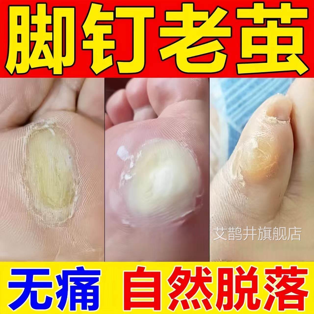 脚钉祛除膏去除厚脚垫老茧死皮根去底板脚掌趾脚指头硬皮软化剂艾