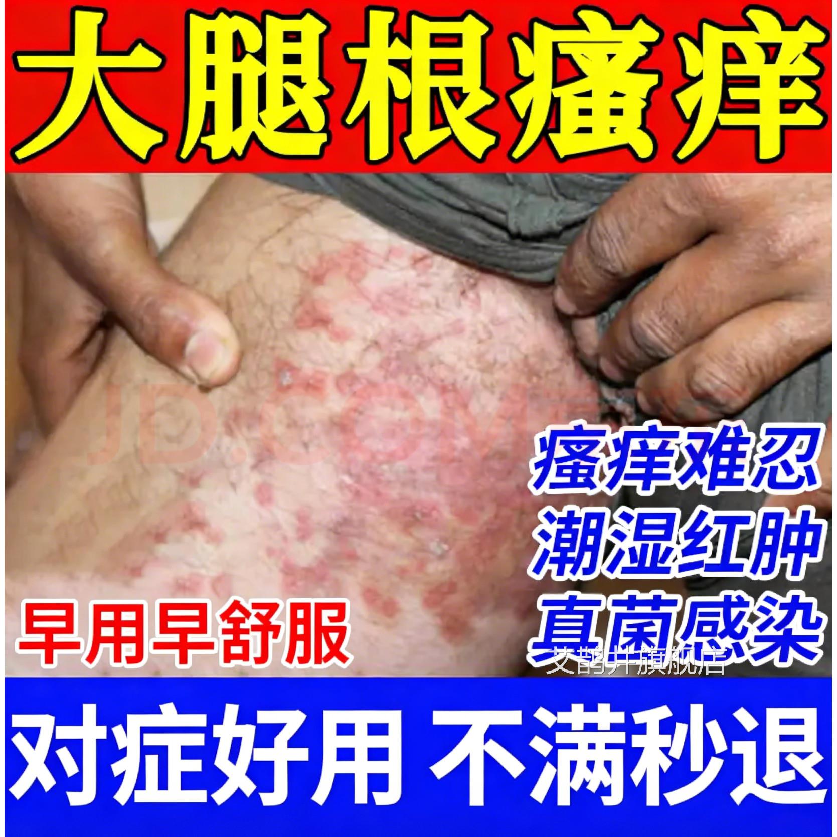 大腿内侧皮肤瘙痒股藓止专痒去真菌根感染私处难闻红肿抑菌用喷剂
