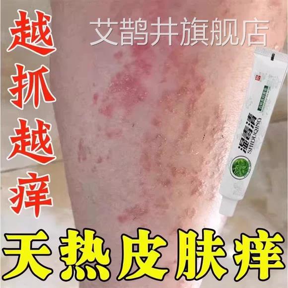夏天小腿痒湿成人止膏出汗痒身上痒天热皮肤疹瘙热疙瘩红疹热毒痒