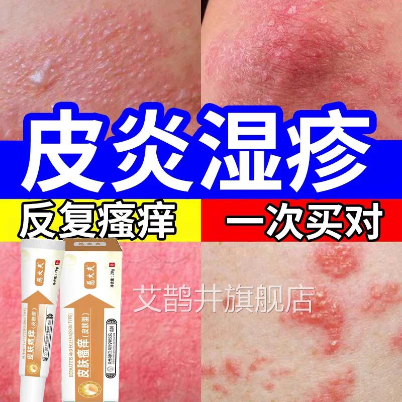 湿毒清软膏湿祛根湿痒毒癣康苗药本抑菌膏百毒王草膏肤毒草清诊艾