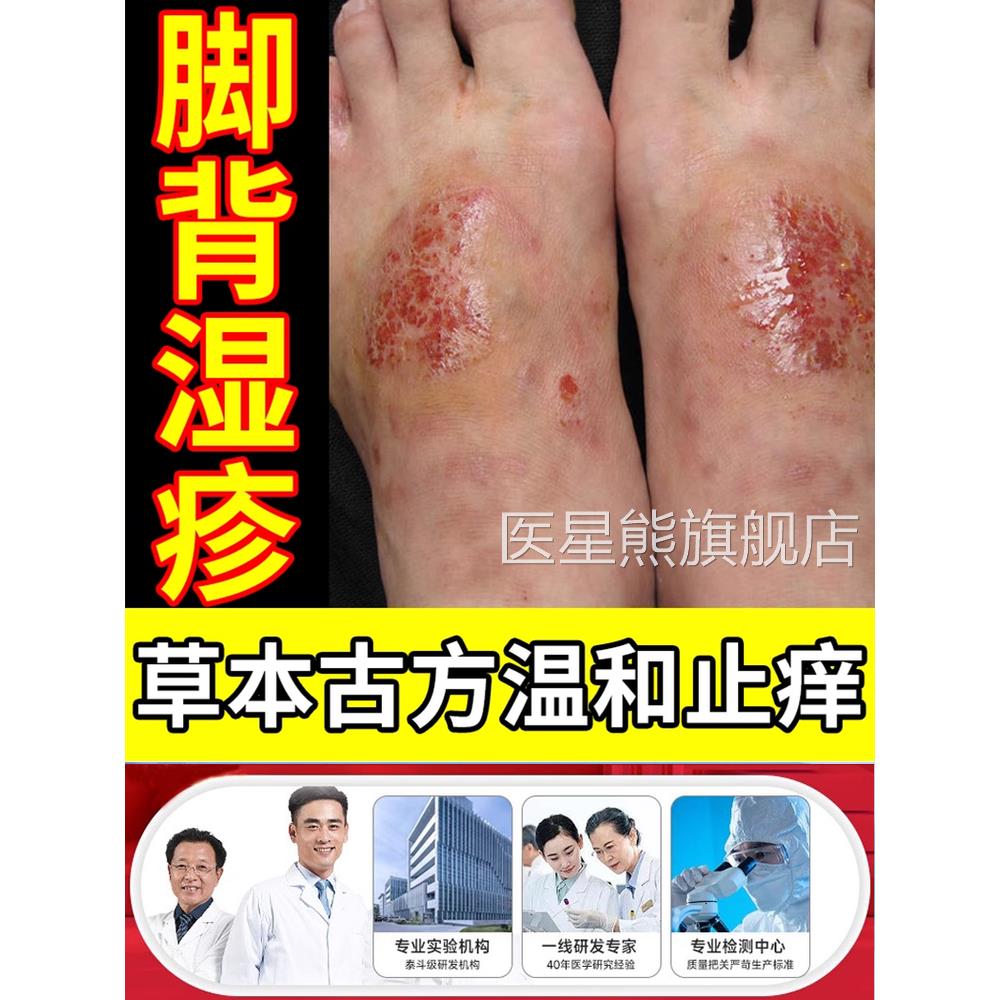 脚背湿疹膏凝胶皮炎湿疹皮癣真菌感染止痒裂口水泡药监备案长HB医
