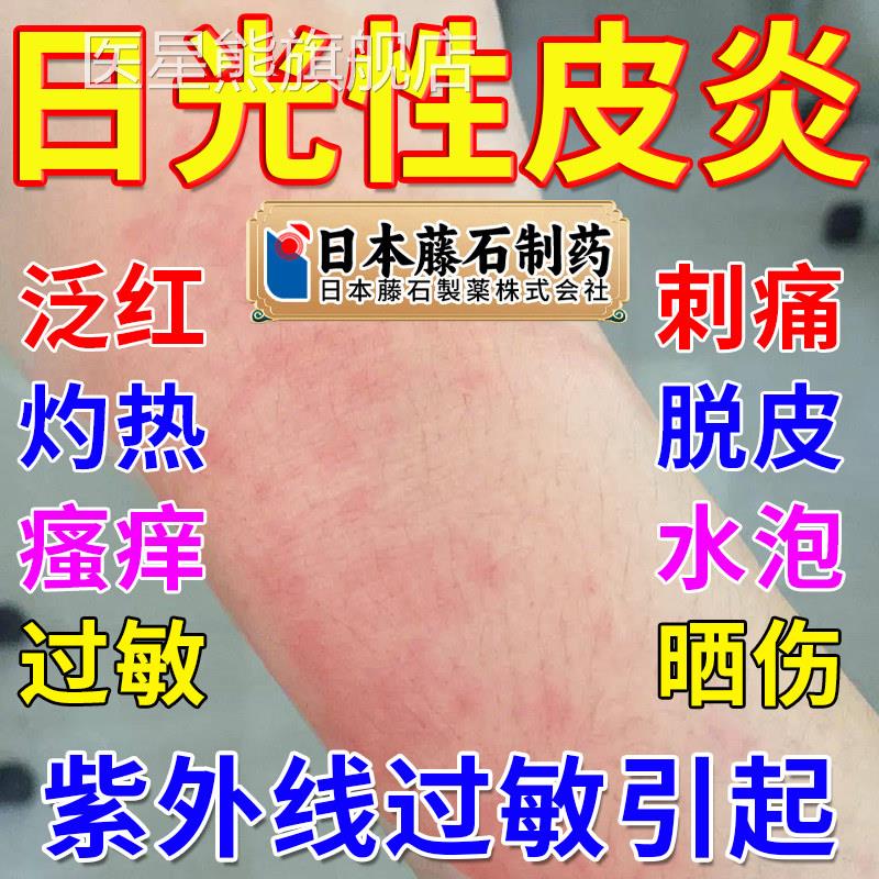 日光性皮皮炎紫外线过敏修复霜专用止痒膏晒伤瘙痒肤荨麻疹喷剂OM
