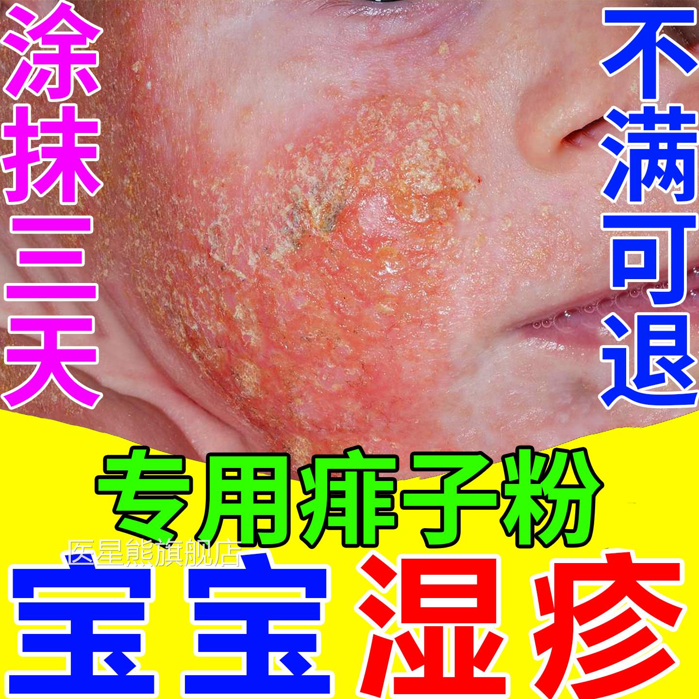 婴儿热痱粉湿珍防淹脖子儿童婴幼儿宝疹宝热痱粉祛痱止痒淹脖子医