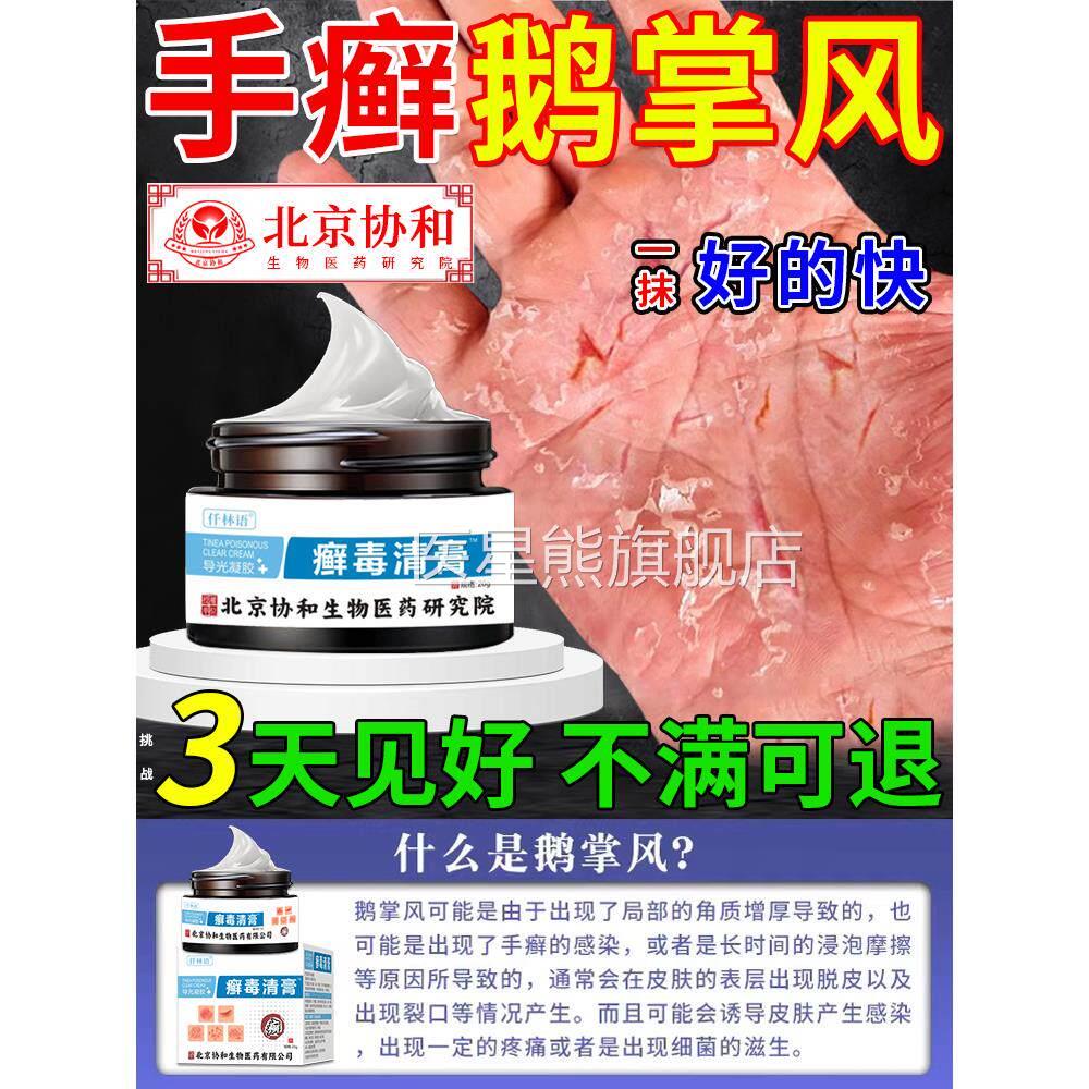 手癣膏脱皮干裂真菌感染足癣止痒去药膏根手上小手水泡鹅掌风ZR医