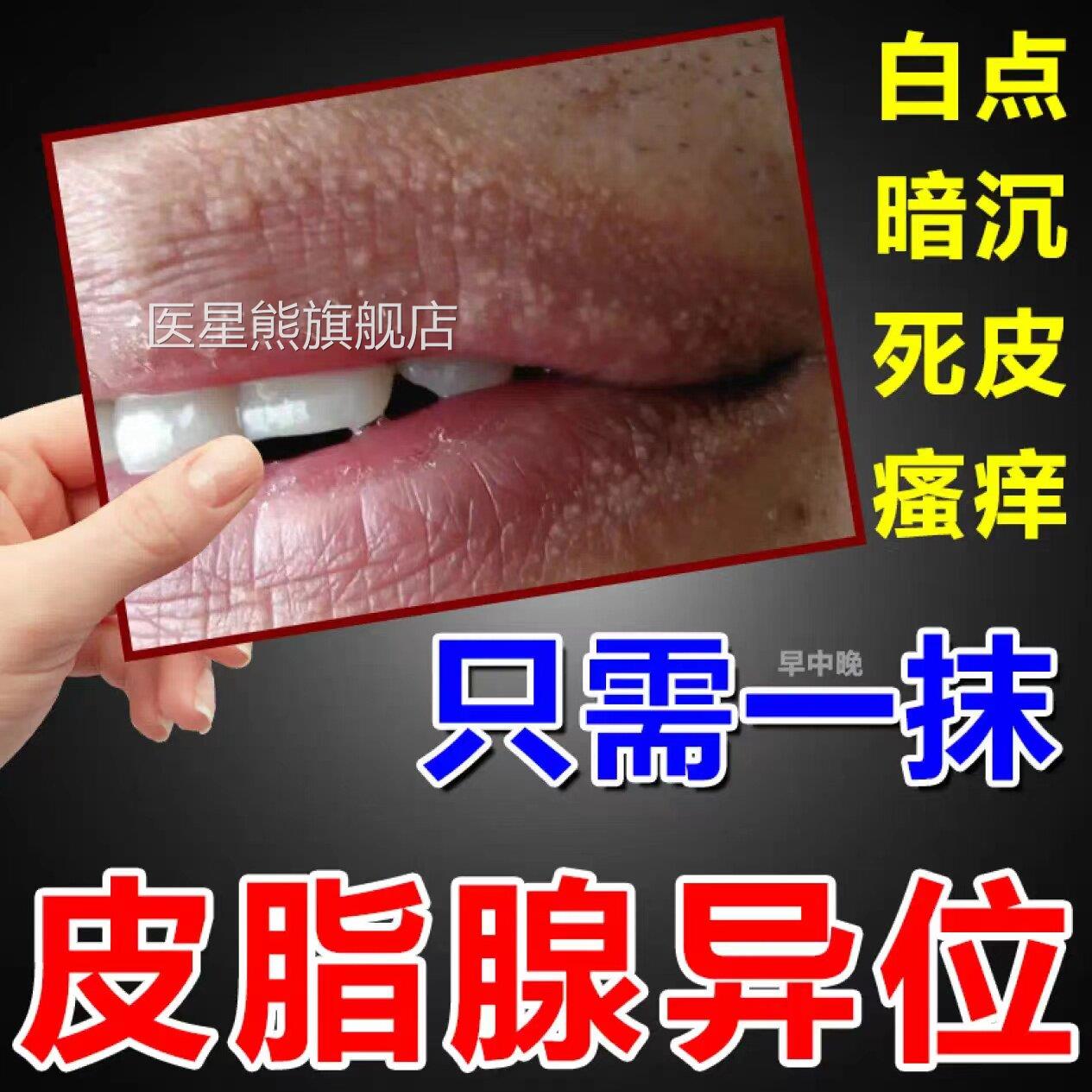 唇炎唇嘴唇干裂脱皮去死皮滋润唇膜膏口角炎修护唇炎专用唇膏医星