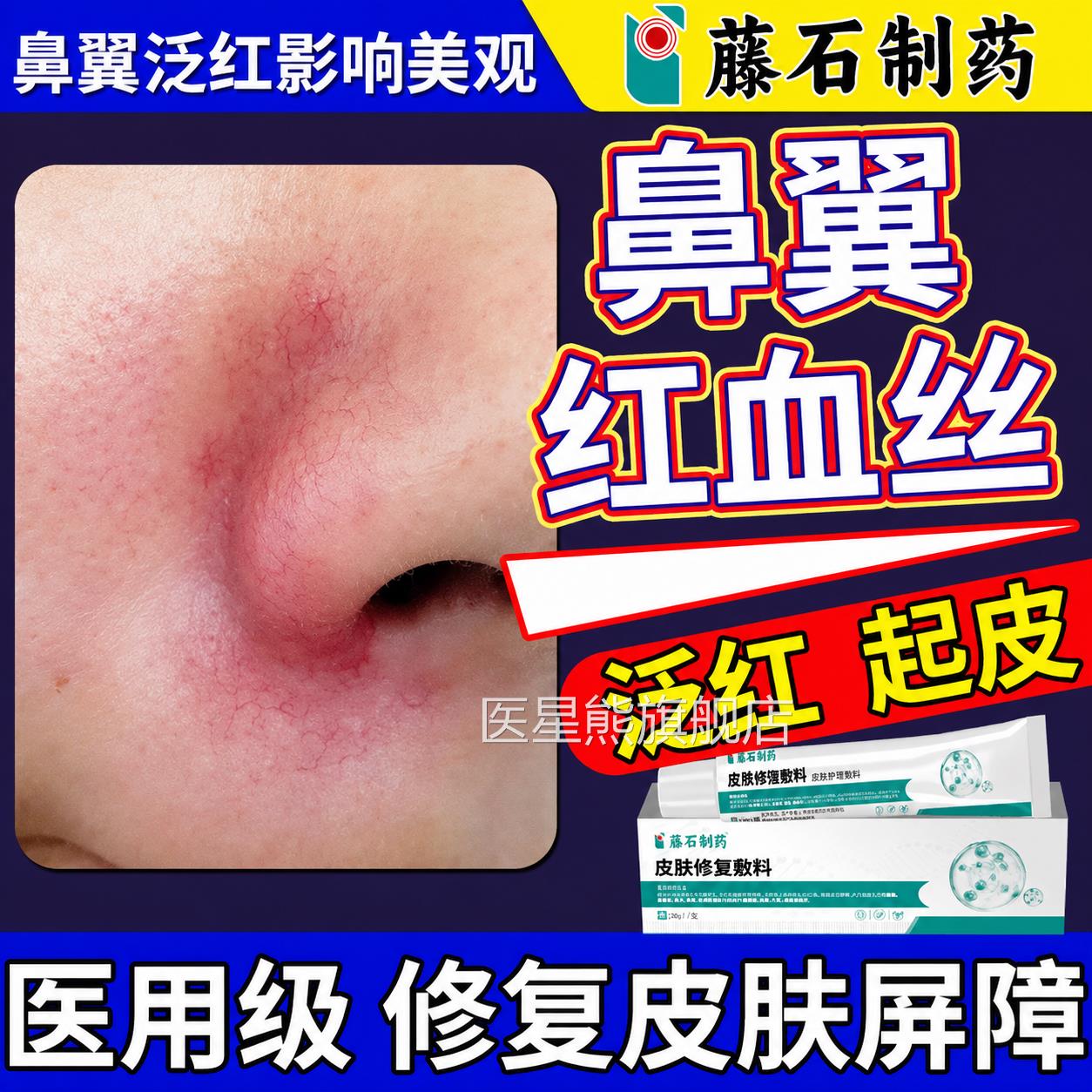 鼻子鼻翼两侧头红血丝专用修复膏去鼻痤疮增厚角质层脂溢皮炎SK医