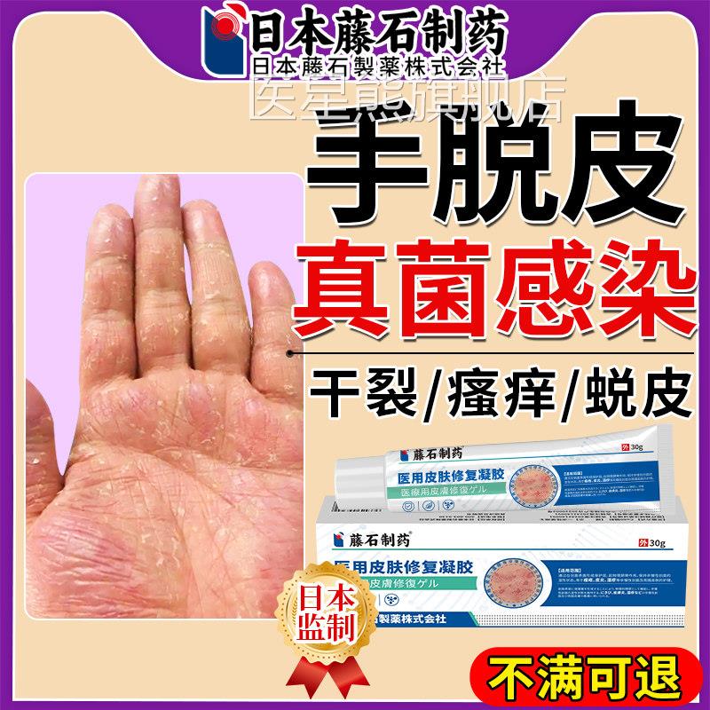 手癣膏脱皮干 干裂真菌感染去手足癣湿疹止癣痒搭毒康关节搭膏药
