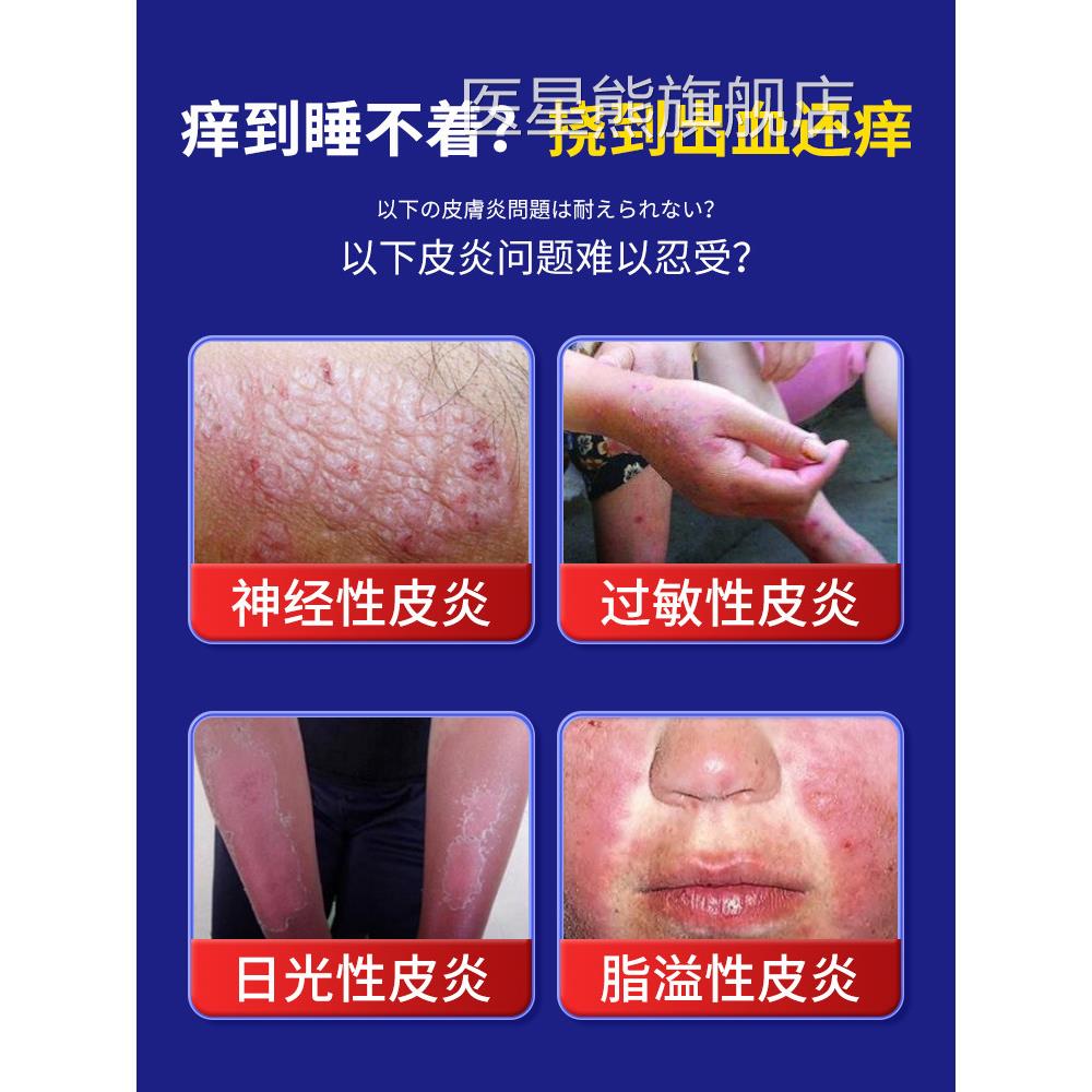 日本顽固神经性皮炎去除外止用膏无激素皮肤瘙痒痒癣藓真菌感染疹