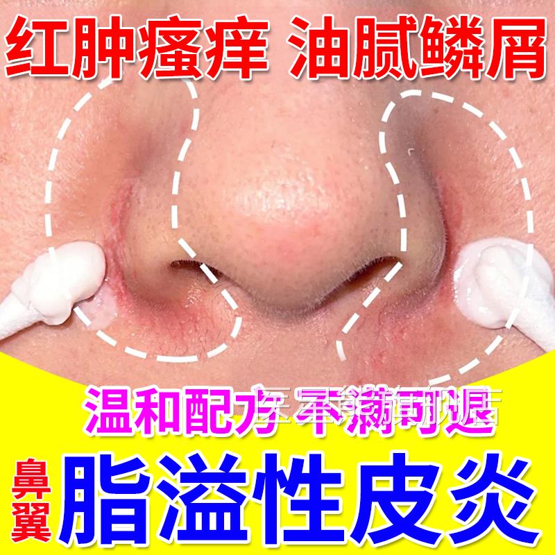 鼻脂溢性皮炎面部面霜软膏鼻子两侧发红马拉色菌干燥起皮脱皮翼UU