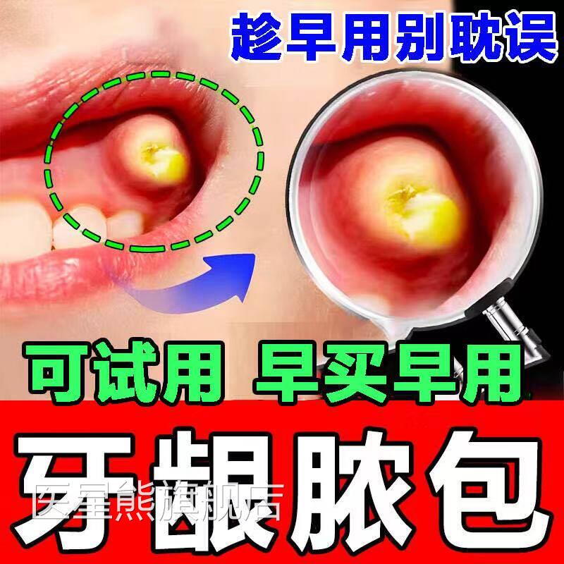 髓牙龈脓包肿包肿痛发炎起包辅助牙根上火牙炎牙根瘘管鼓包喷雾剂