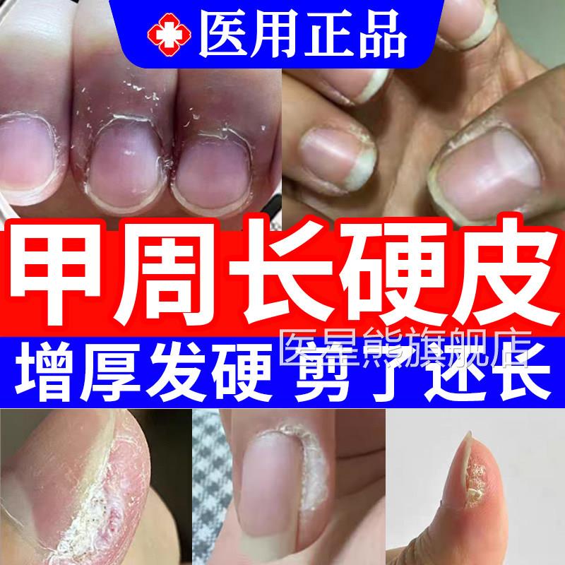 软化甲周硬手指指甲边缘去死皮去手部角质皮老茧硬茧神器软化剂TT