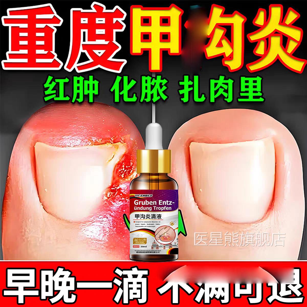 甲夹沟炎辅助治疗专用效特大药房器神脚趾根甲往肉里长手指膏嵌肉