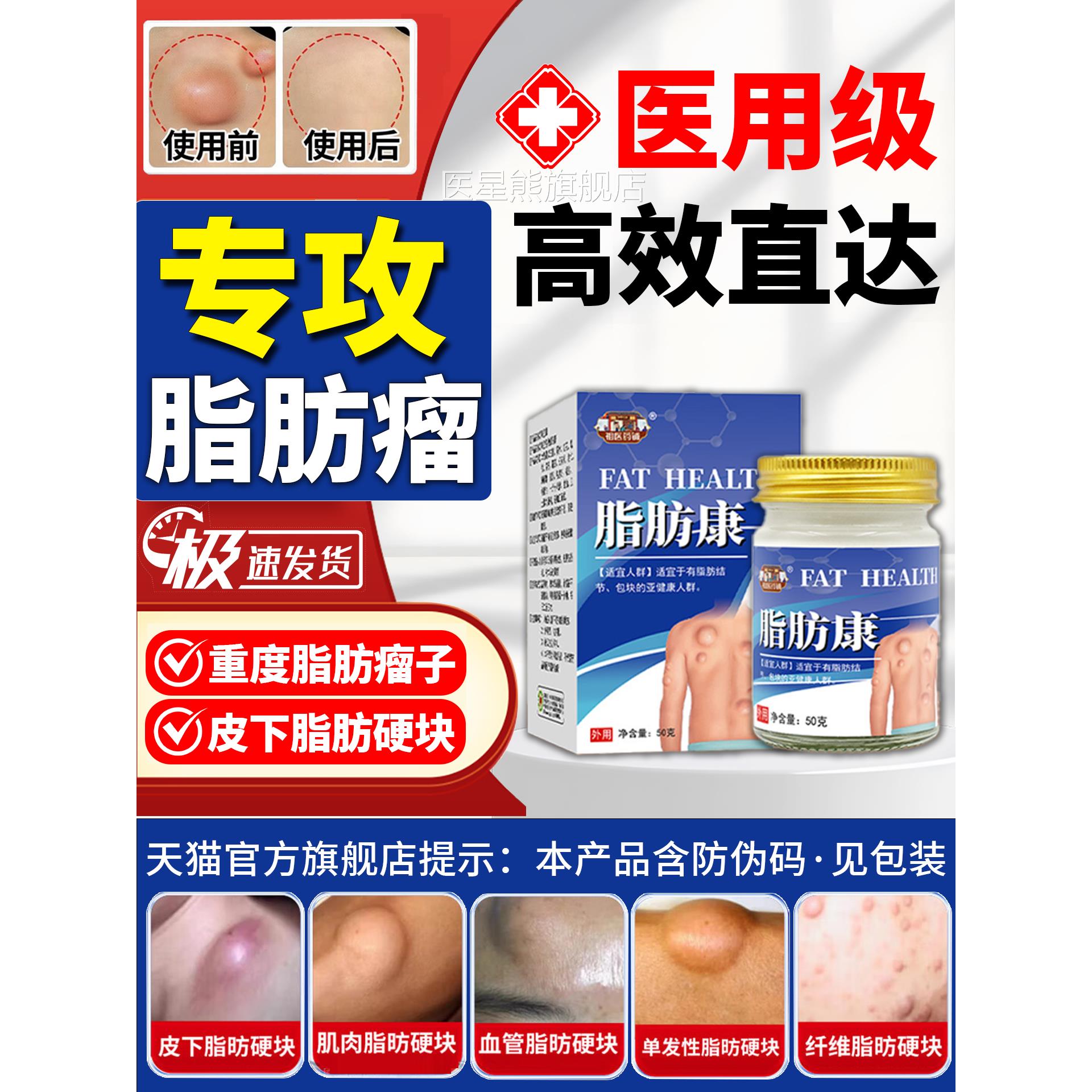 脂肪瘤消瘤膏鼓包肿硬块皮下脂肪瘤去除神器治官旗方舰店疗纤维瘤