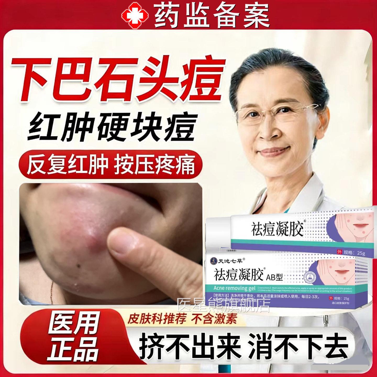 祛石头痘痘下巴脸上长石头豆下巴反复长痘痤疮膏结节硬块脓囊豆肿