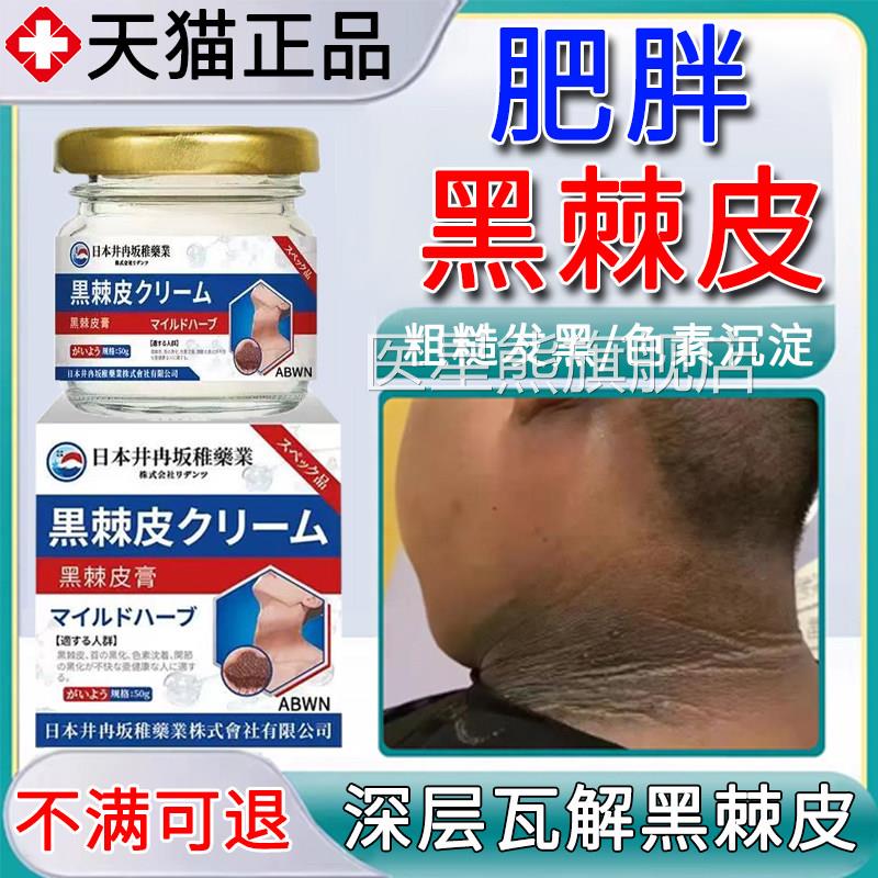 专去脖色子黑棘皮药膏用治脖子黑素沉淀肥胖症儿童可用神器医用型