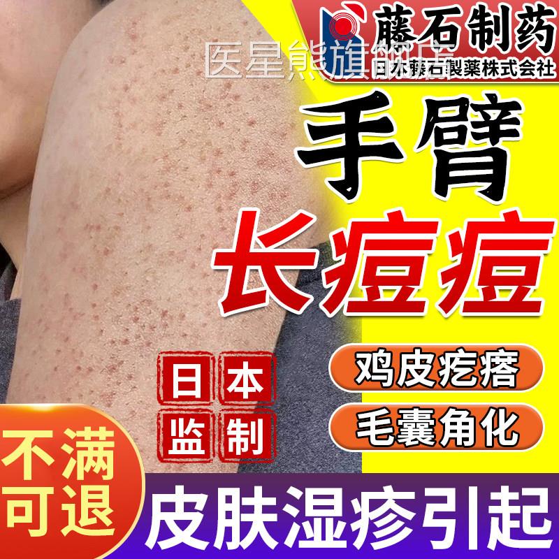 手臂毛囊炎专用喷雾剂胳膊上长小疙小红点鸡皮肤瘩角化药监备案OM