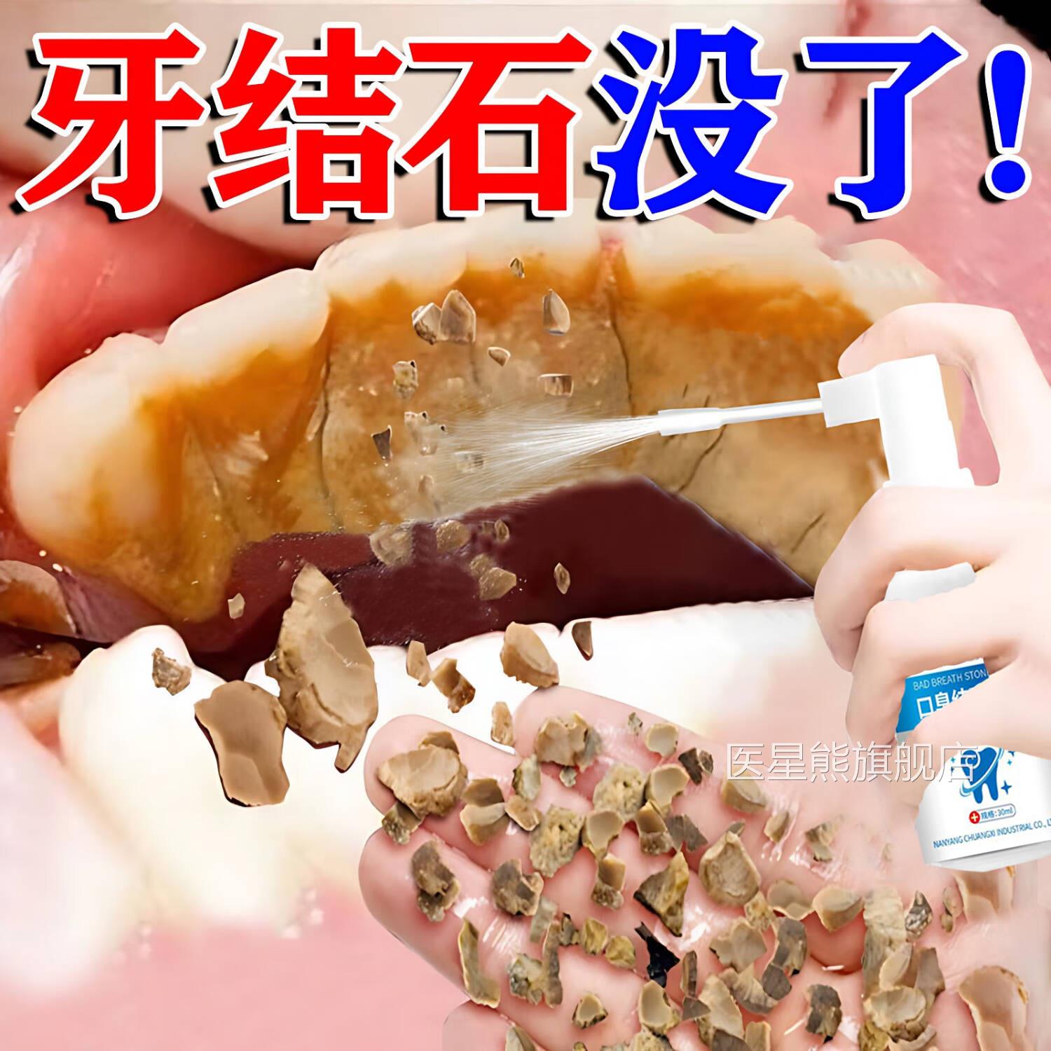 牙结石去除器牙石牙齿污垢烟茶渍溶解水漱口清洁牙黄牙垢神器医星