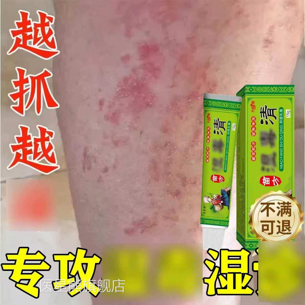 肚子肚皮周围红斑专除湿止痒膏皮肤止痒去外用顽固皮炎用根医星熊