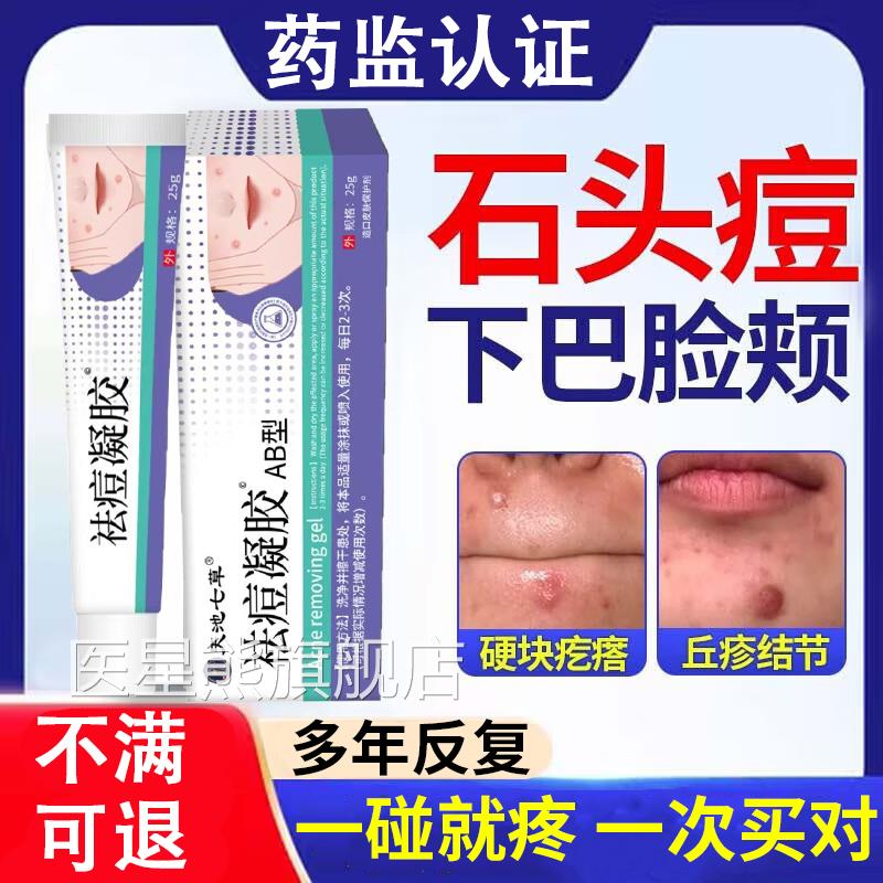 火石头痘痘囊肿结节硬块痘脸上下巴长硬疙瘩脓包型痤疮毛囊炎疖子