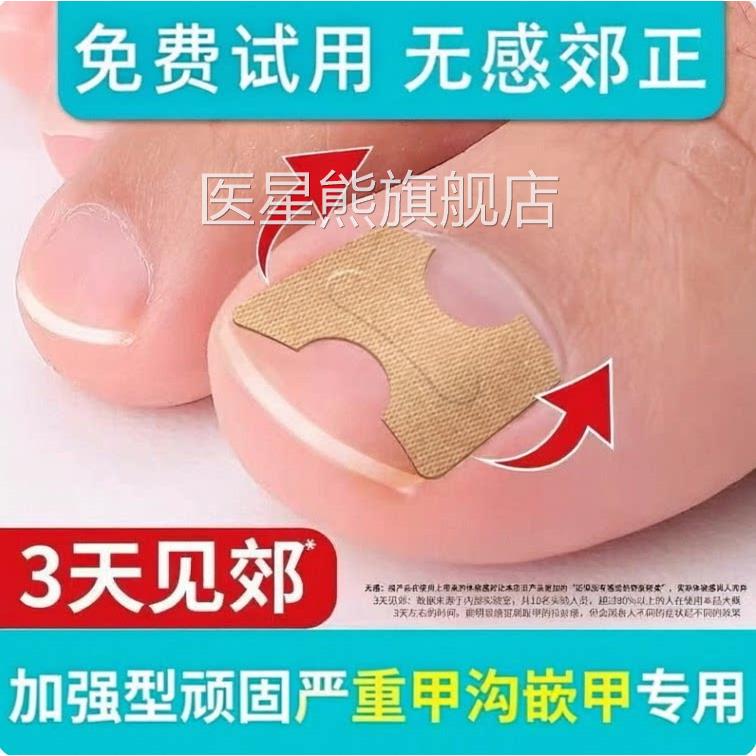 正甲贴甲沟垫片甲沟嵌甲专用趾指甲矫正器卷炎防脚甲往肉长贴纠正