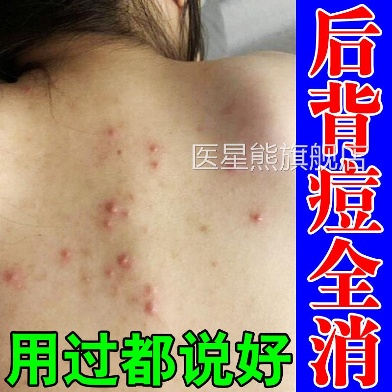 马拉色菌前胸后背痘身上背部祛痘除螨去痘膏祛痱子红疹起红疙瘩痒