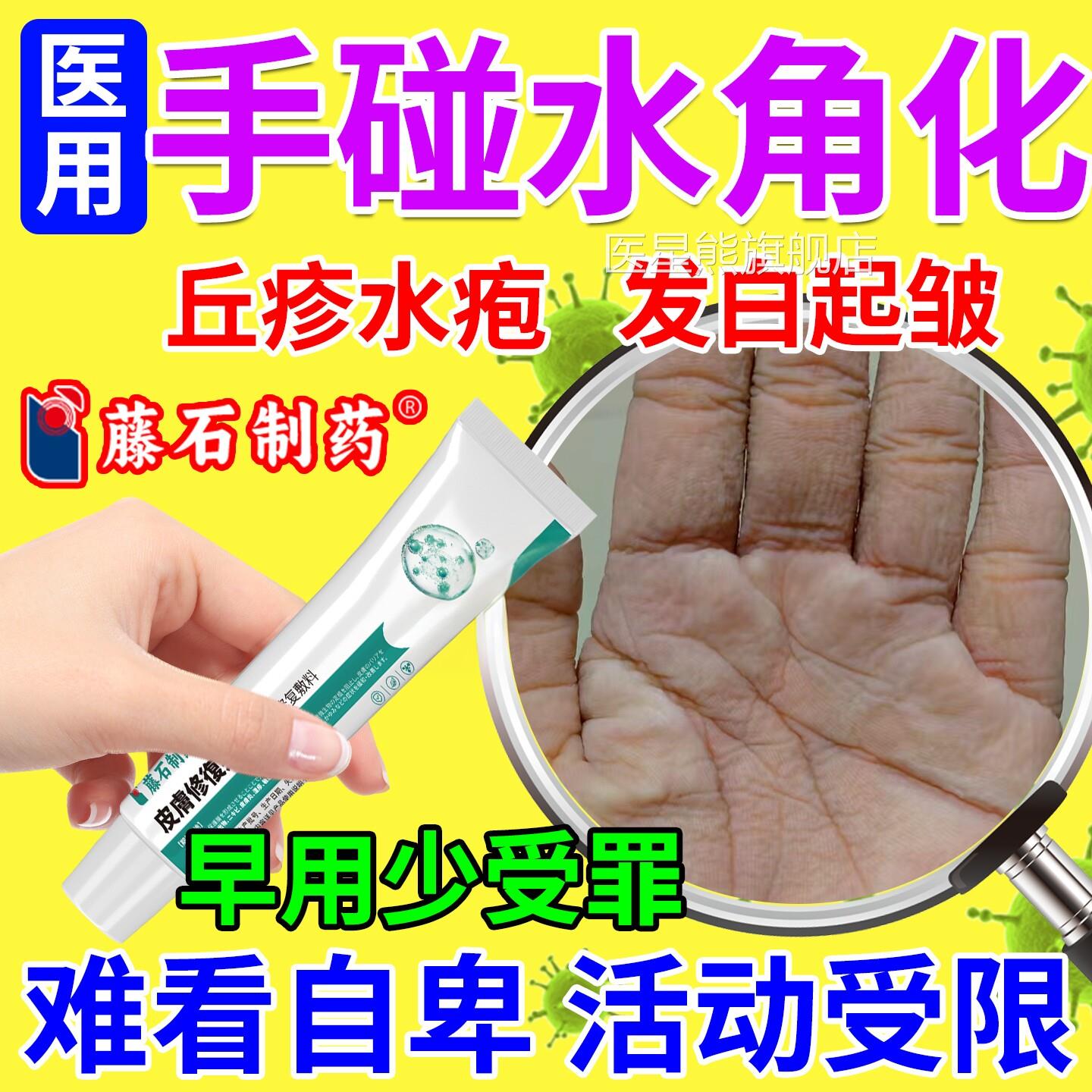 水膏源性肢端角化症手碰水就皱外用软膏水泡丘疹手癣角化开裂SK医