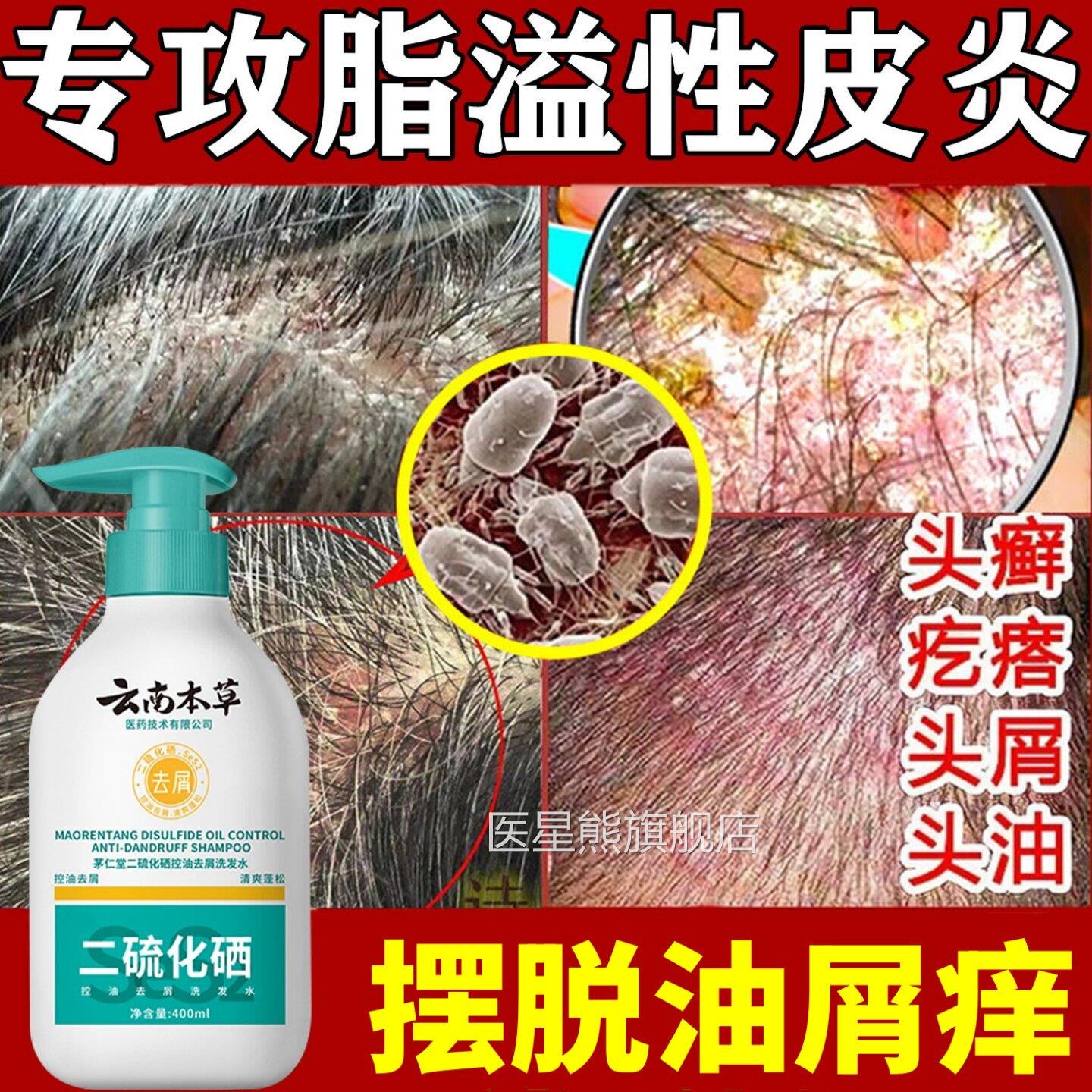 云南本草二硫化硒皮脂溢性洗发毛囊炎止抑炎菌痒头皮癣旗控油中药