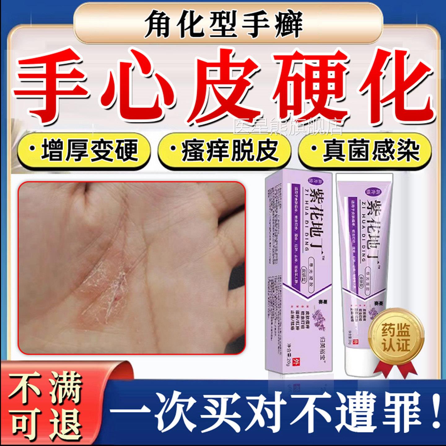 手心黄硬皮增厚角质手癣膏专用脱皮干裂真菌感染鹅风掌手癣膏药TT