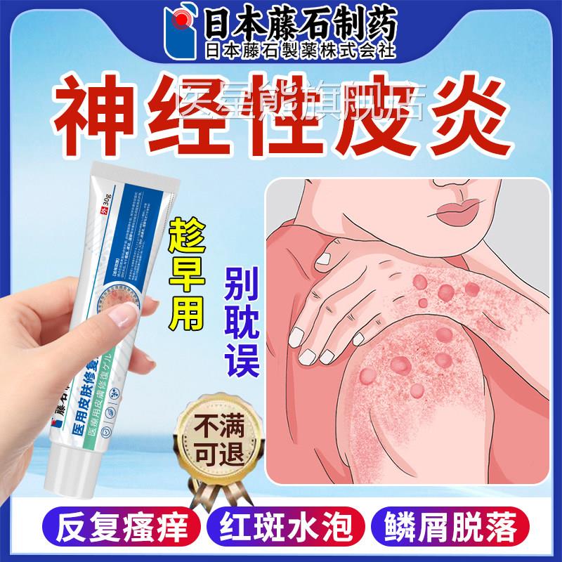 手臂神经性皮炎皮肤病真菌感染止顽痒外用固药监备案毒癣康软膏OM