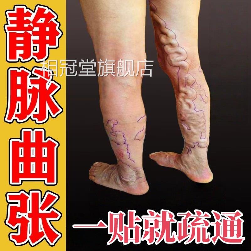静脉曲张腿部青筋凸起蚯蚓腿血管胀红血丝医用贴膏官方正肿品相冠