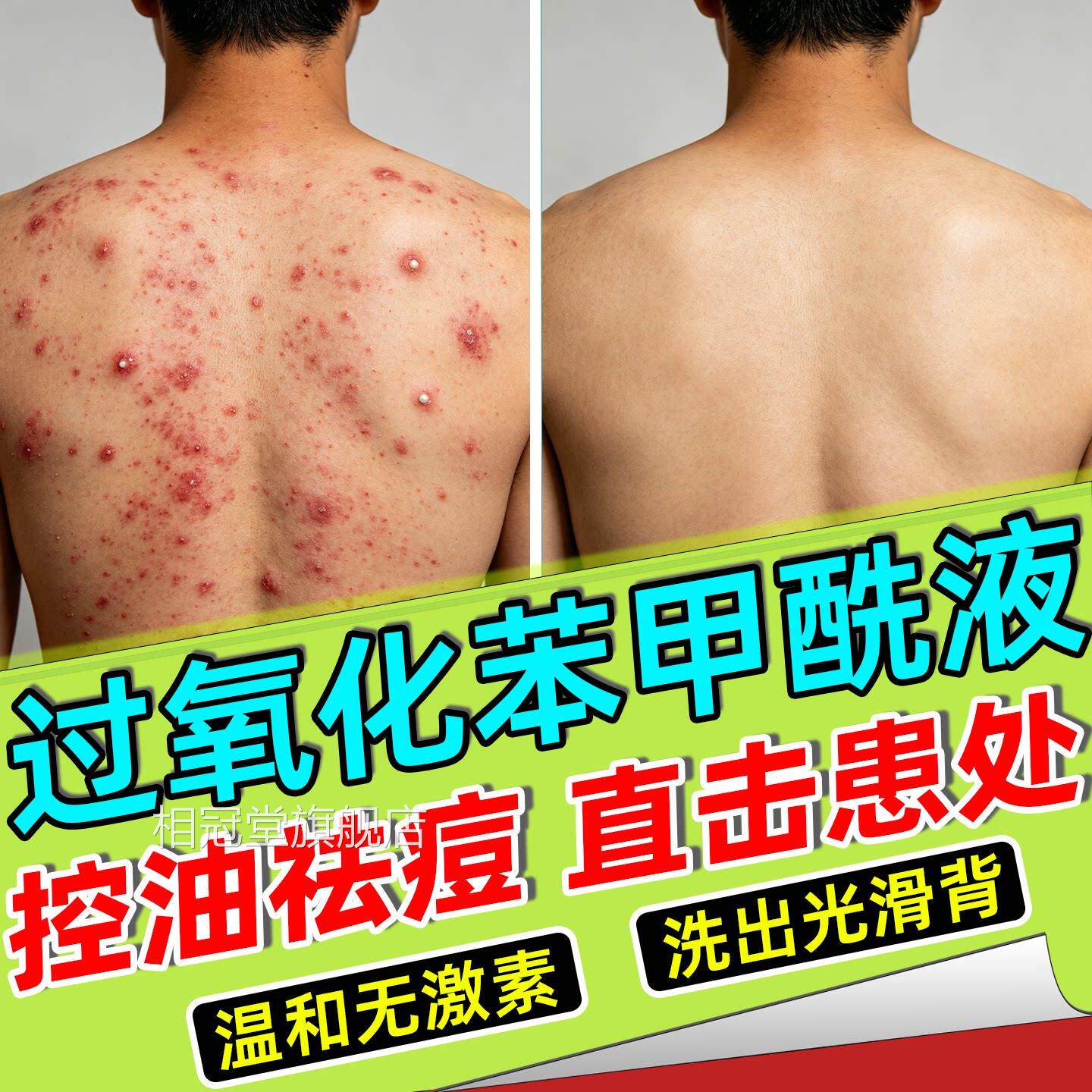 马拉色菌前胸后部祛痘沐浴露身体乳洗背液粉末黑印沐浴露溶剂控油